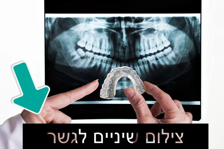 צילום שיניים לגשר